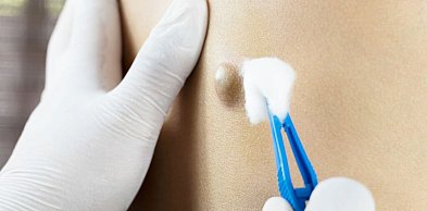 Torbiel włosowa – dlaczego dochodzi do nawrotów i jak wygląda leczenie?