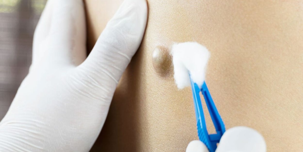 Torbiel włosowa – dlaczego dochodzi do nawrotów i jak wygląda leczenie?